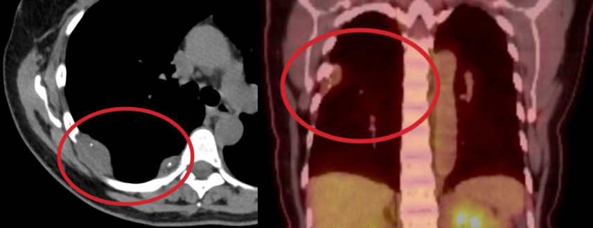 PET/CT exam follow-up
