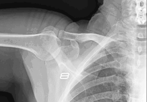 Flexion-Extension Dynamic Digital Radiography X-ray