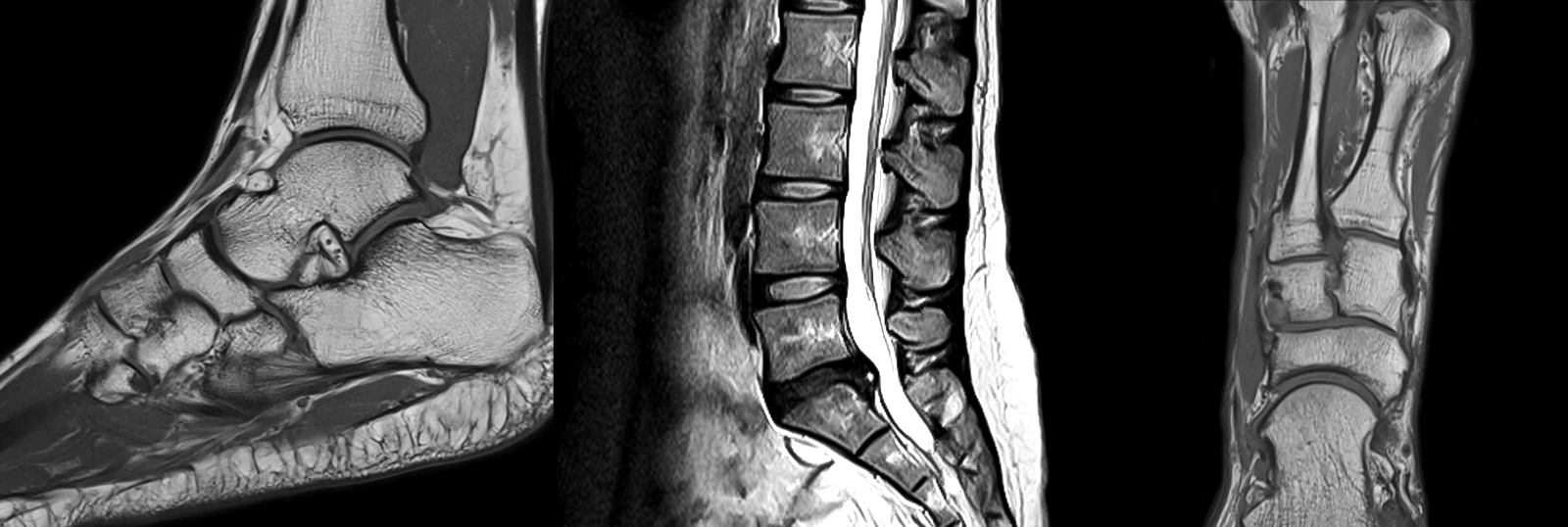 Lumbar spine MRI