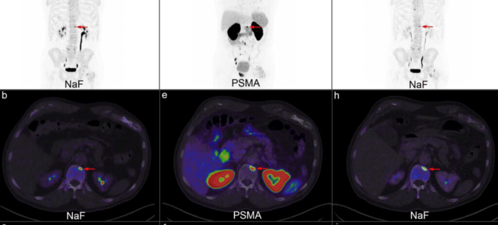PSMA nuclear medicine scan