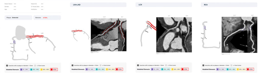 Soft plaque analysis
