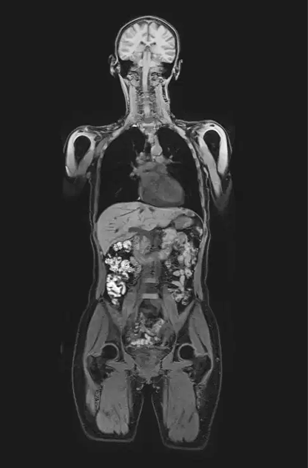 Whole body MRI scan