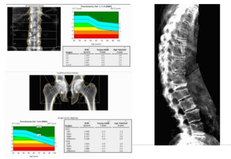 Bone Density Scan (DEXA)  Rowe Creavin Medical Practice