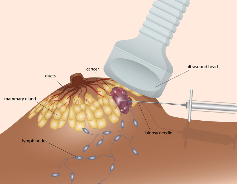 biopsy_diagram