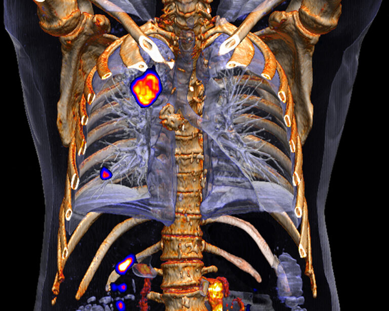 PET/CT ZwangerPesiri Radiology