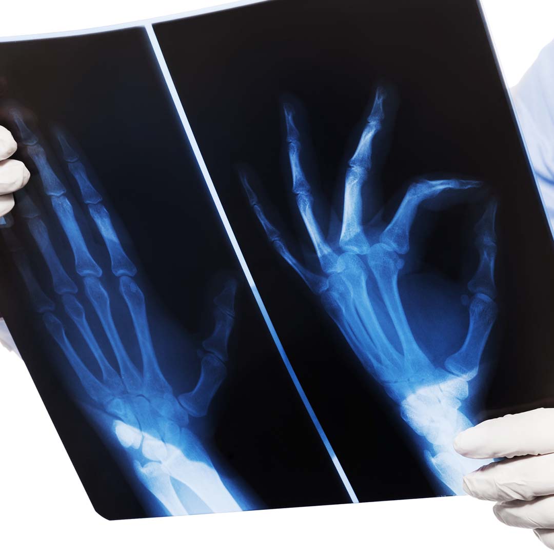 doctor looking at an x-ray image of a hand