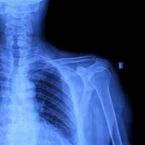 An X-ray image of a person's shoulder.