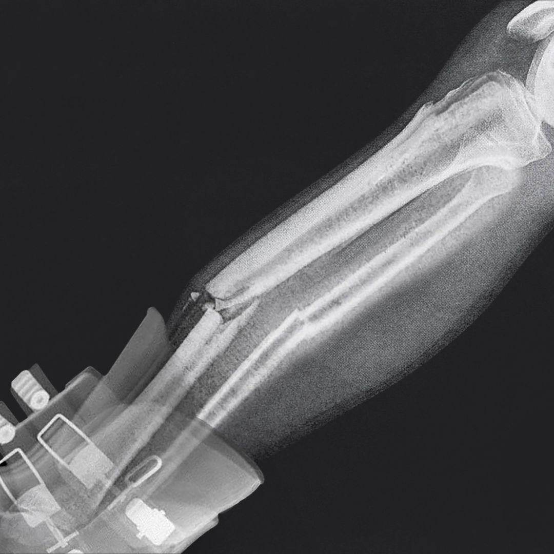 An x-ray of a broken leg.