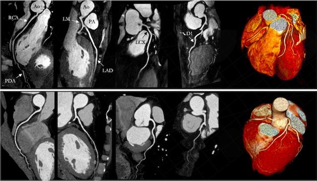 MR Angiography