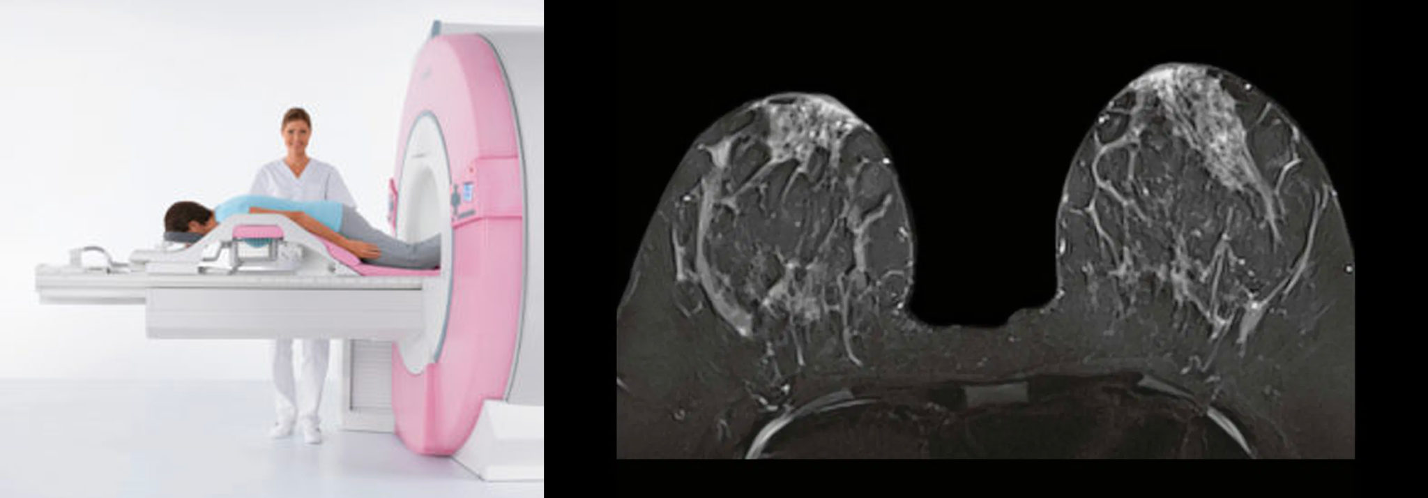 Breast MRI - Zwanger-Pesiri Radiology