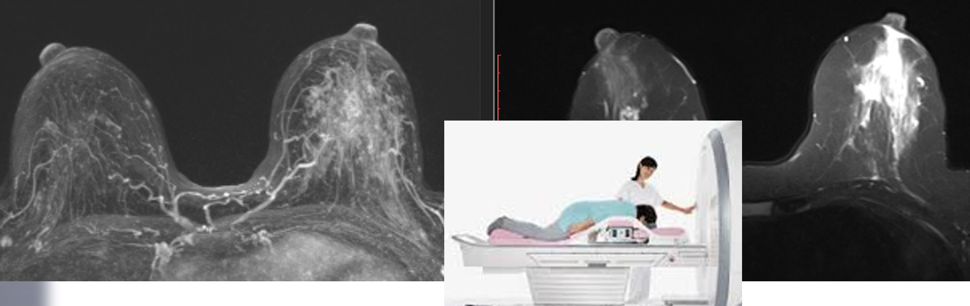breast-mri